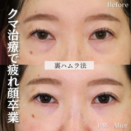 症例解説：裏ハムラ法でクマのふくらみ解消！